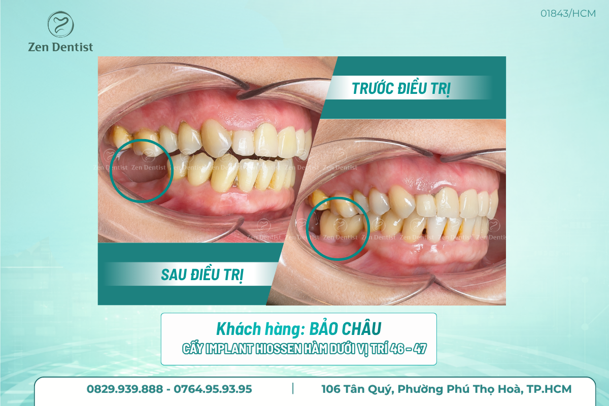 Trồng răng Implant uy tín an toàn tại Zen Dentist