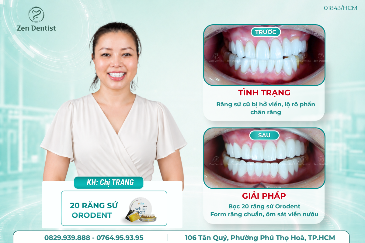 Những trường hợp có thể được cân nhắc bọc răng sứ sớm