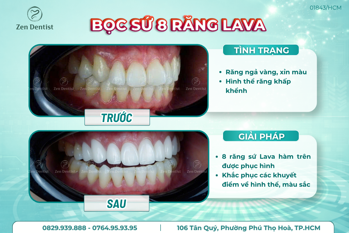 Dịch vụ bọc răng sứ 