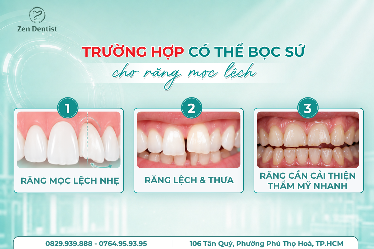 Những trường hợp có thể bọc sứ cho răng mọc lệch