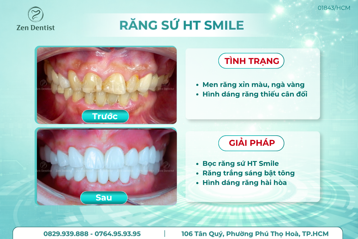 Bọc sứ cho răng mọc lệch