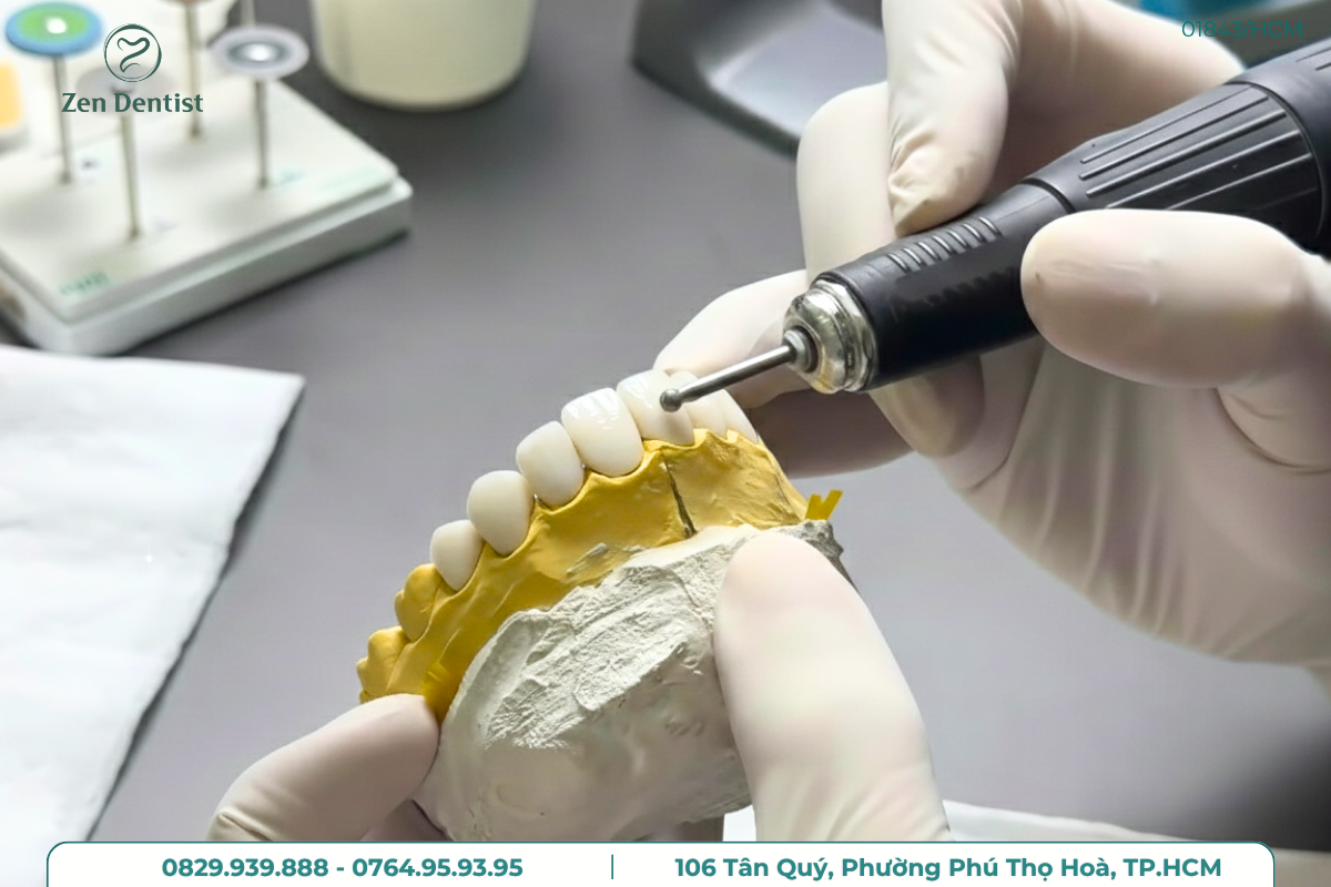 Bọc sứ cho răng mọc lệch tại Zen Dentist