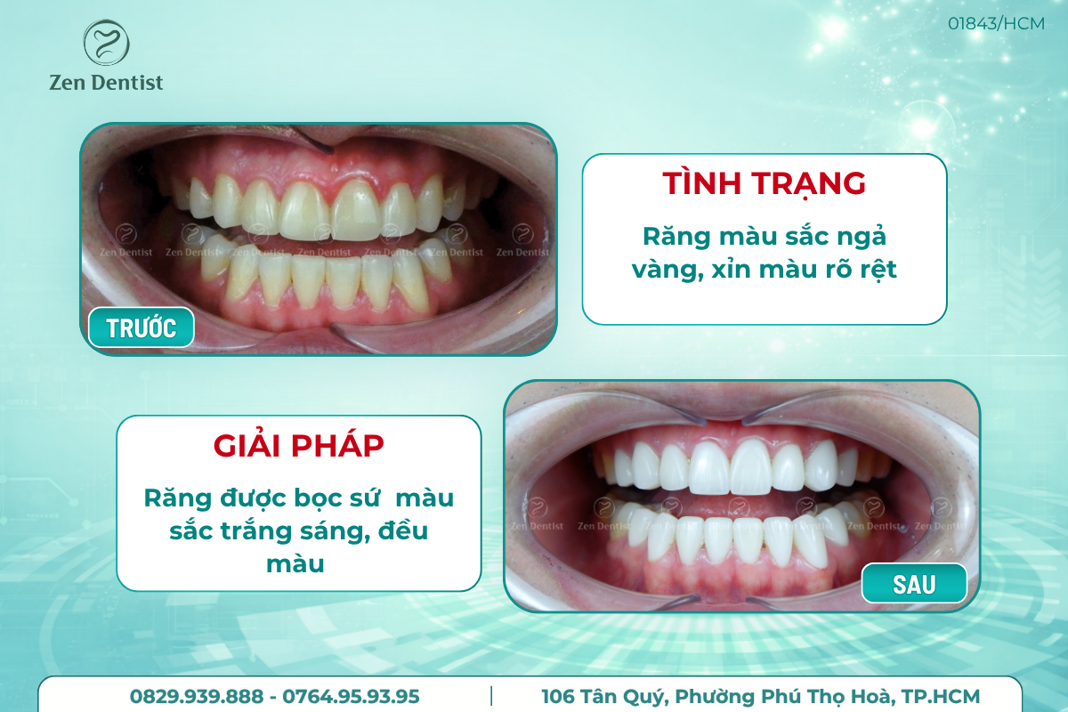 Làm răng sứ an toàn tại Zen Dentist