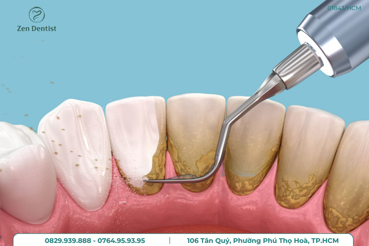 Cạo vôi răng ở đâu tốt