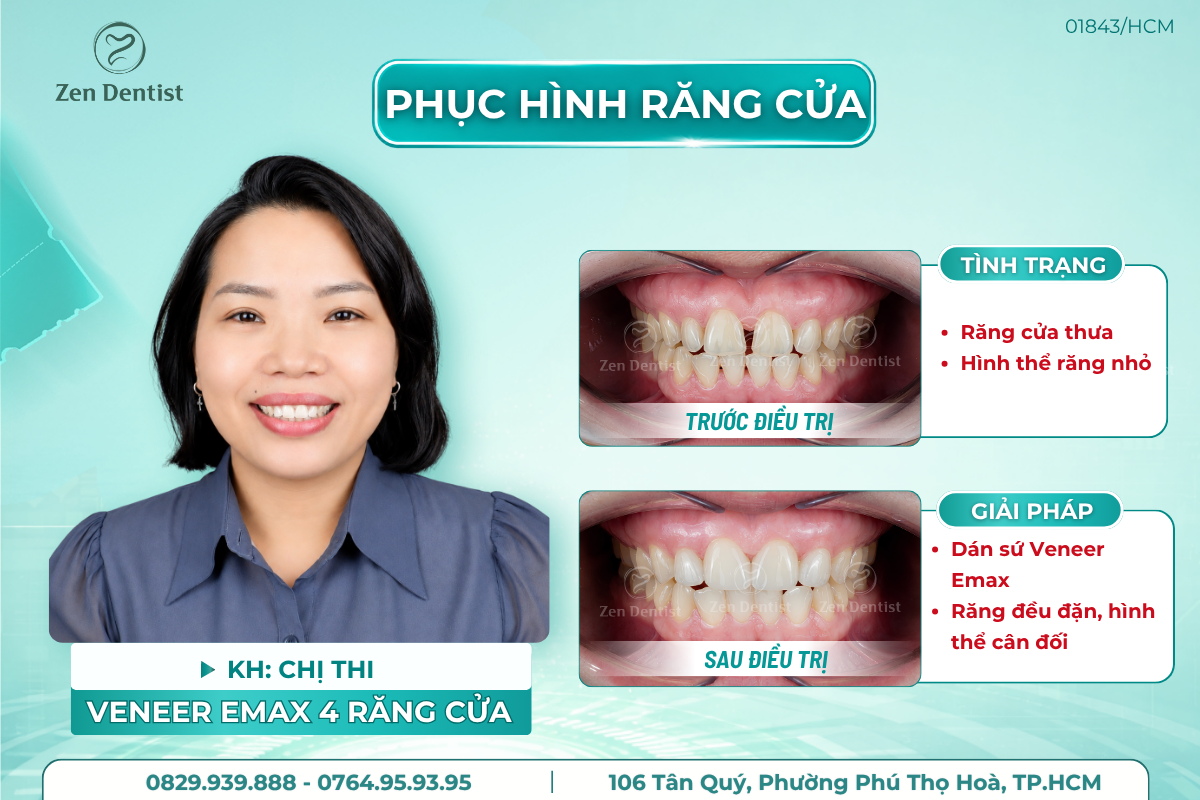 Dịch vụ dán răng sứ Veneer tại Zen Dentist