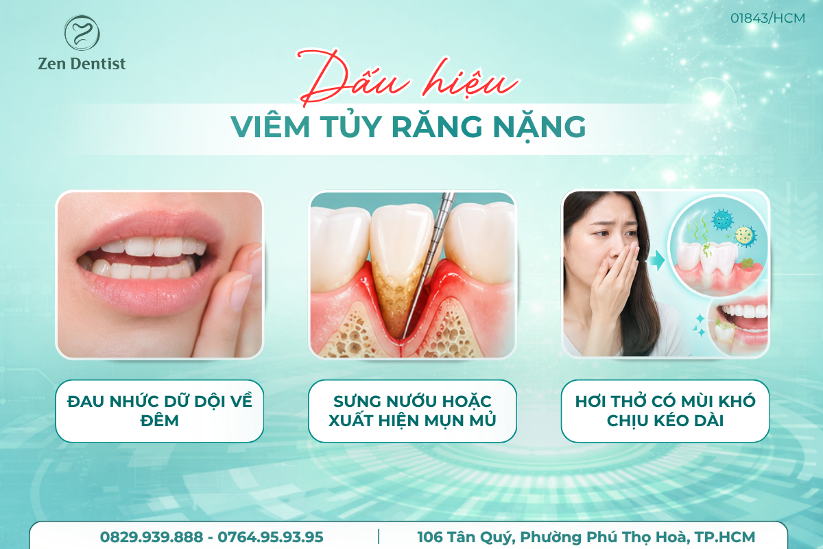 Những dấu hiệu viêm tủy răng đã tiến triển nặng
