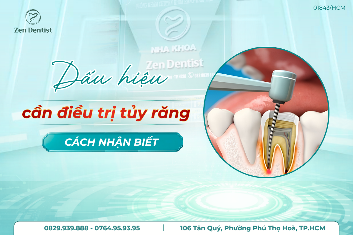 dấu hiệu cần điều trị tủy răng