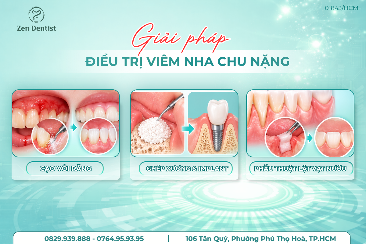 Giải pháp điều trị viêm nha chu nặng