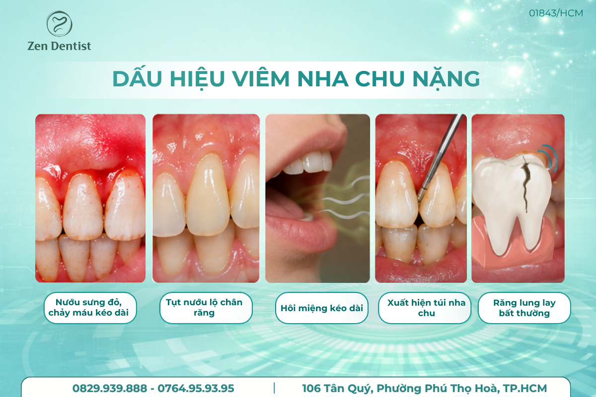 Dấu hiệu viêm nha chu nặng thường gặp