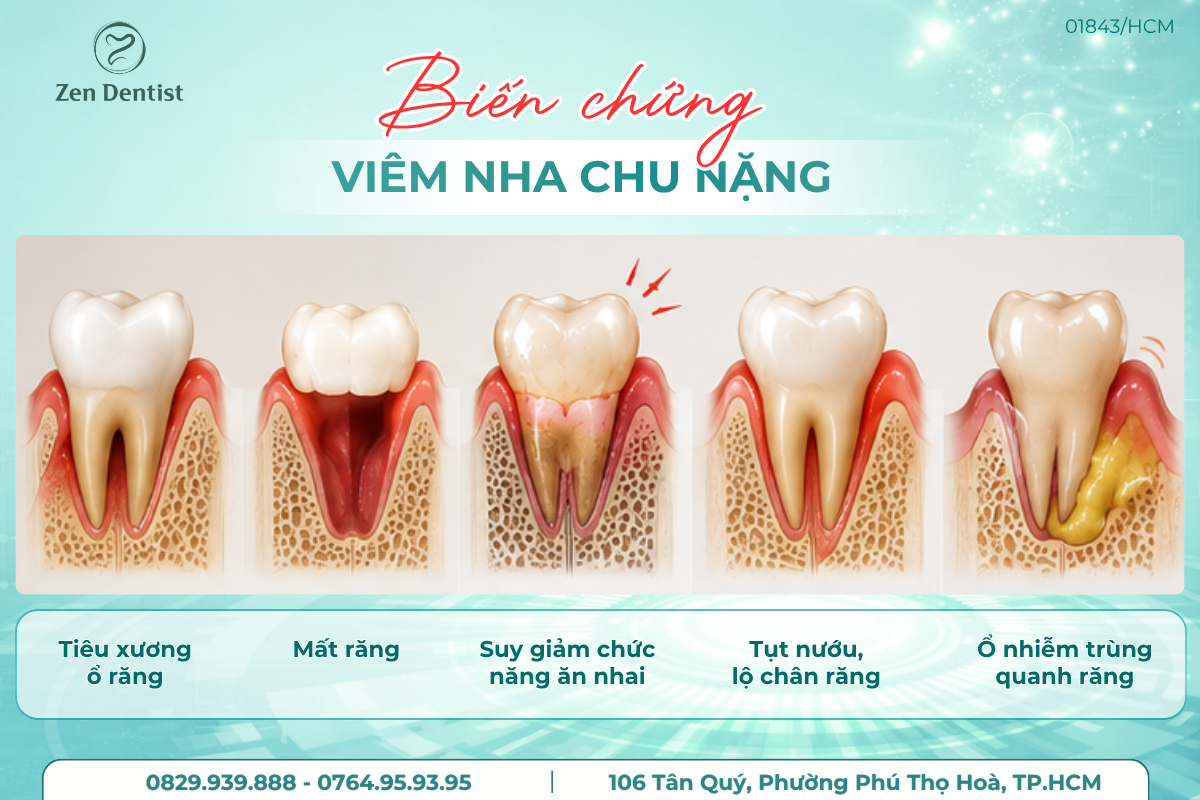 Biến chứng của viêm nha chu nặng