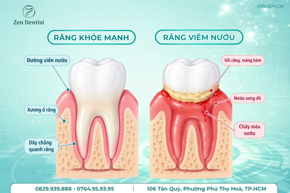 Những dấu hiệu viêm nướu giai đoạn đầu