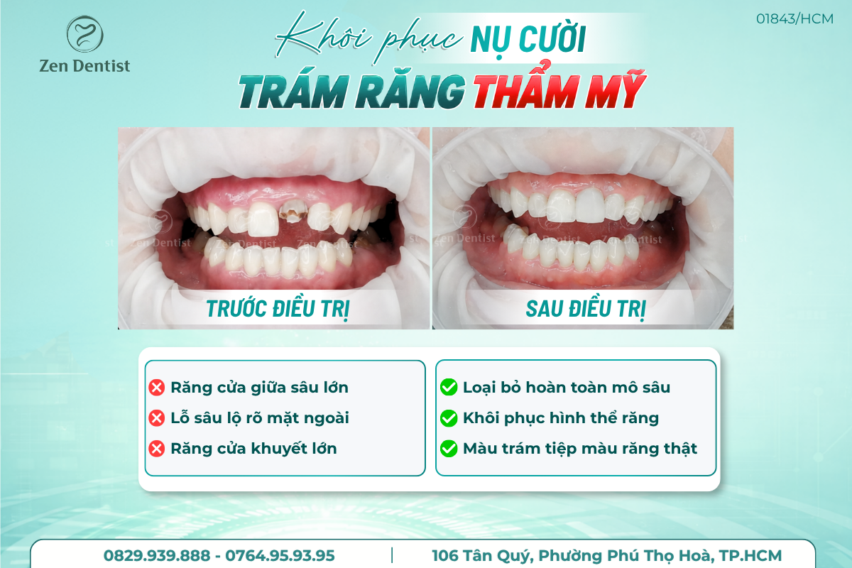 Khôi phục nụ cười bằng phương pháp trám răng