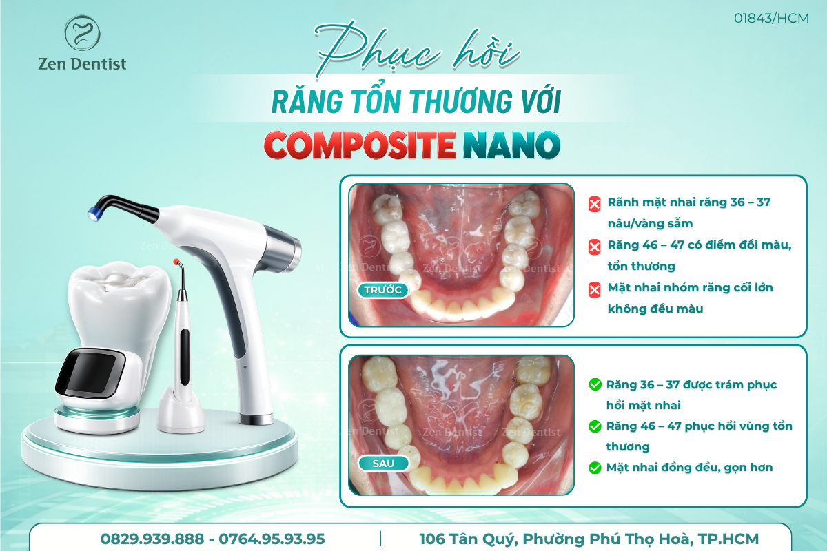 Chọn nha khoa uy tín để phục hồi răng tổn thương