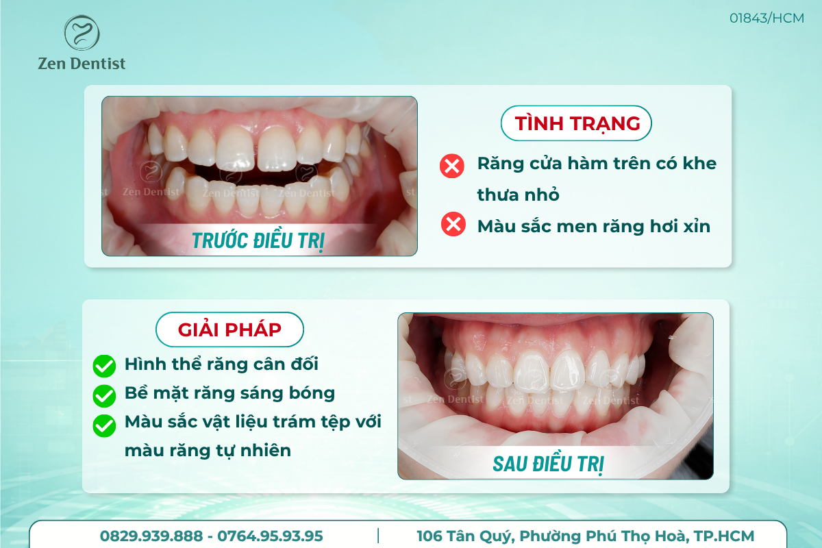 Trám răng tại Zen Dentist