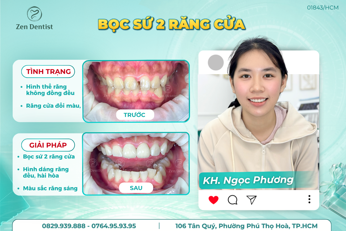 Zen Dentist - Địa chỉ bọc sứ uy tín gần đây
