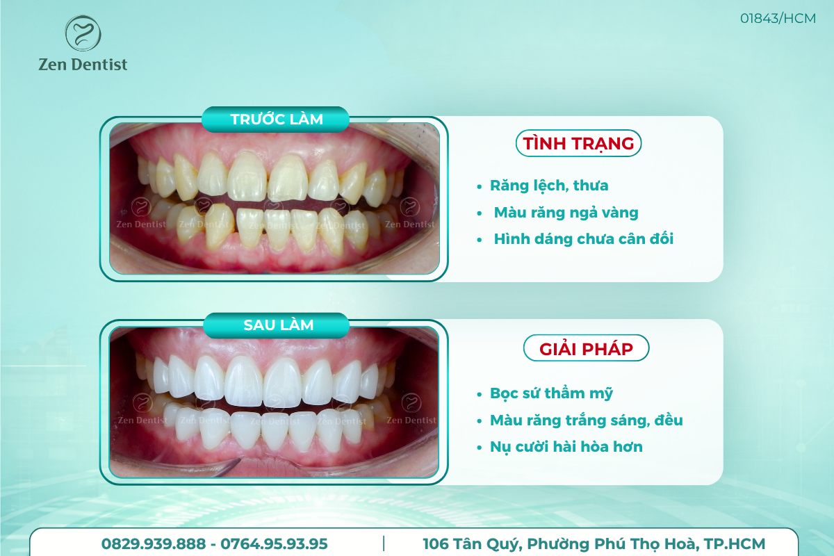 Bọc răng sứ an toàn tại Zen Dentist