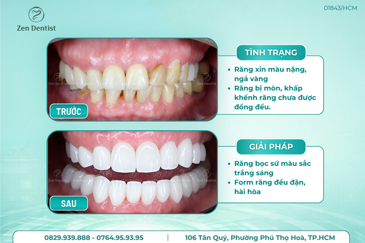 Bọc răng sứ tại Zen Dentist