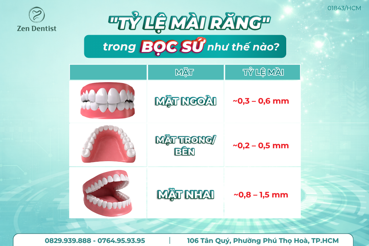 Tỷ lệ mài răng trong bọc sứ như thế nào?
