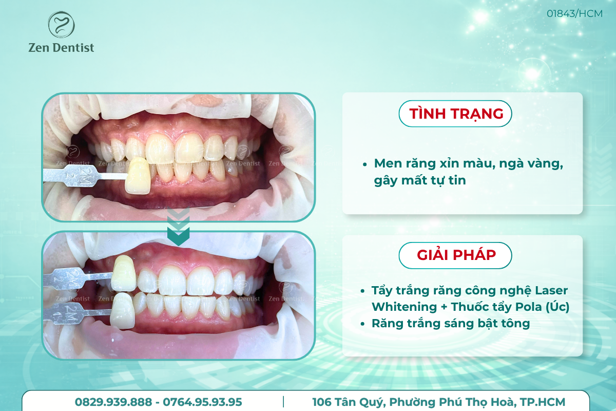 Tẩy trắng răng