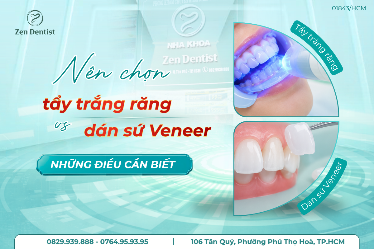 nên tẩy trắng răng hay dán sứ veneer