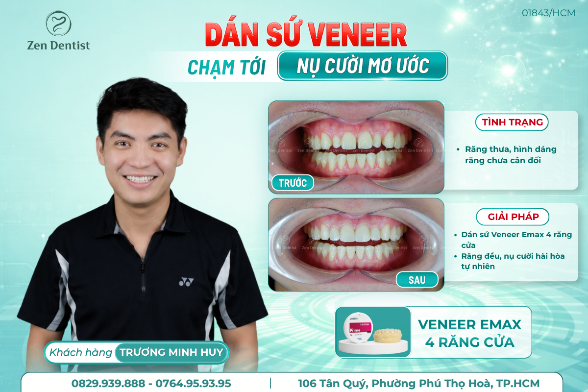 Khi nào nên dán sứ Veneer?