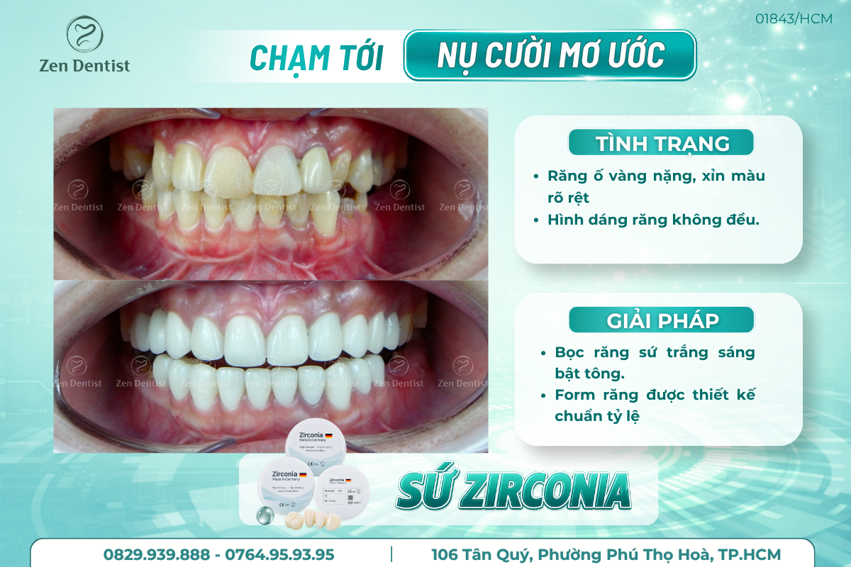 Ưu đãi răng sứ Zirconia Đức cao cấp chỉ 1 triệu 500