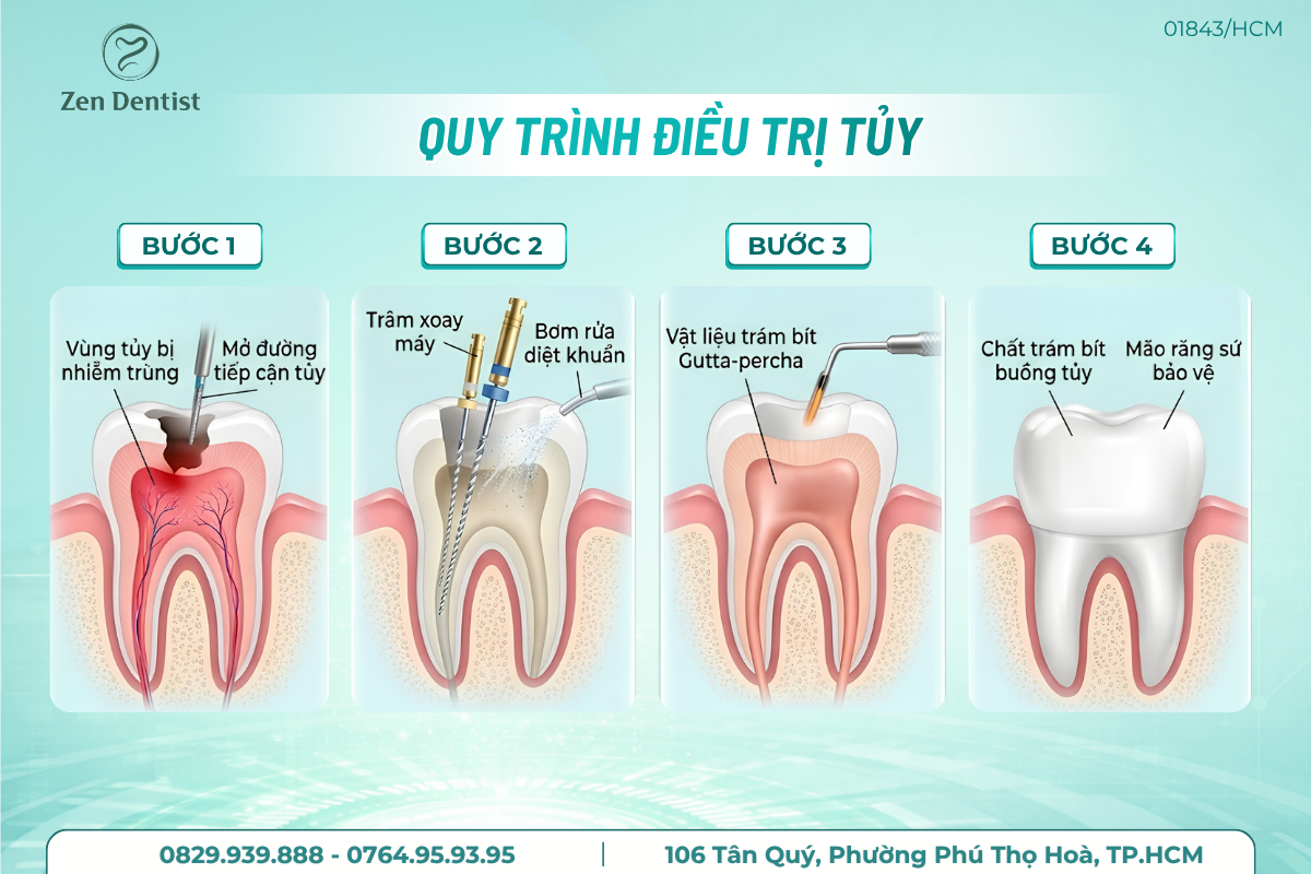Quy trình điều trị tủy răng