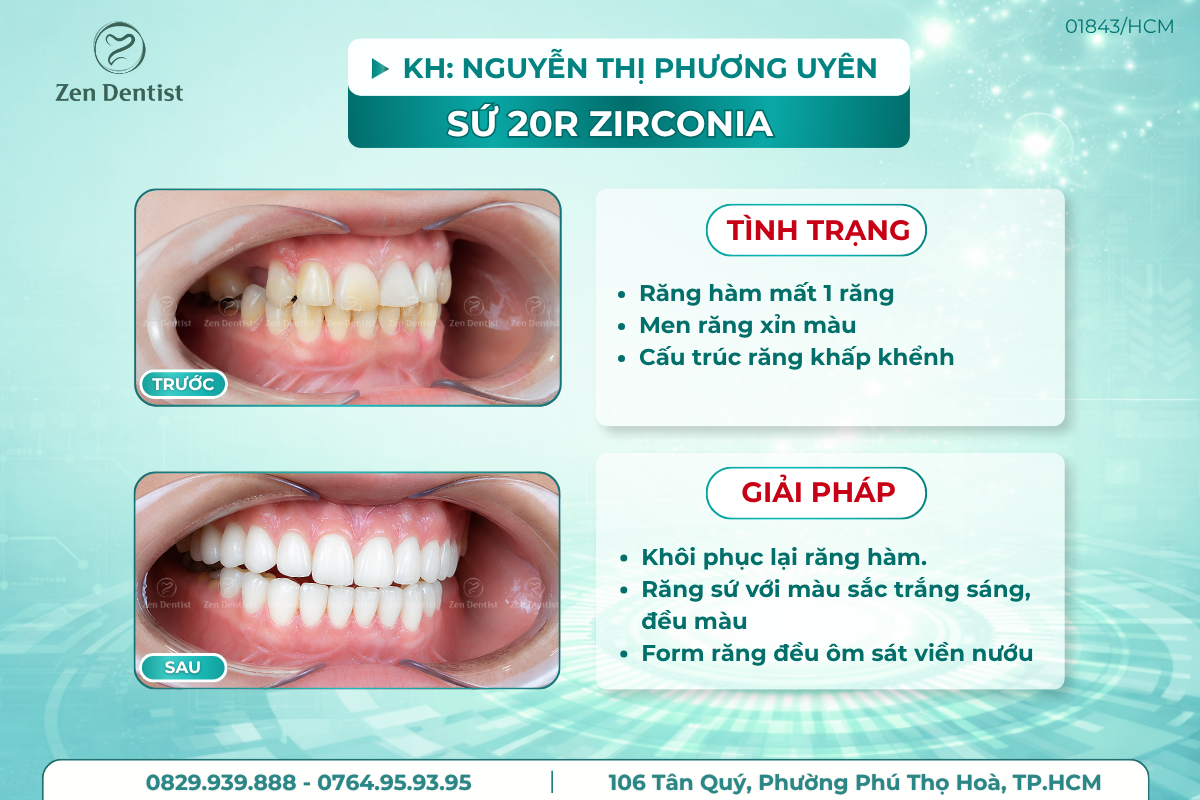 Phục hình răng sứ