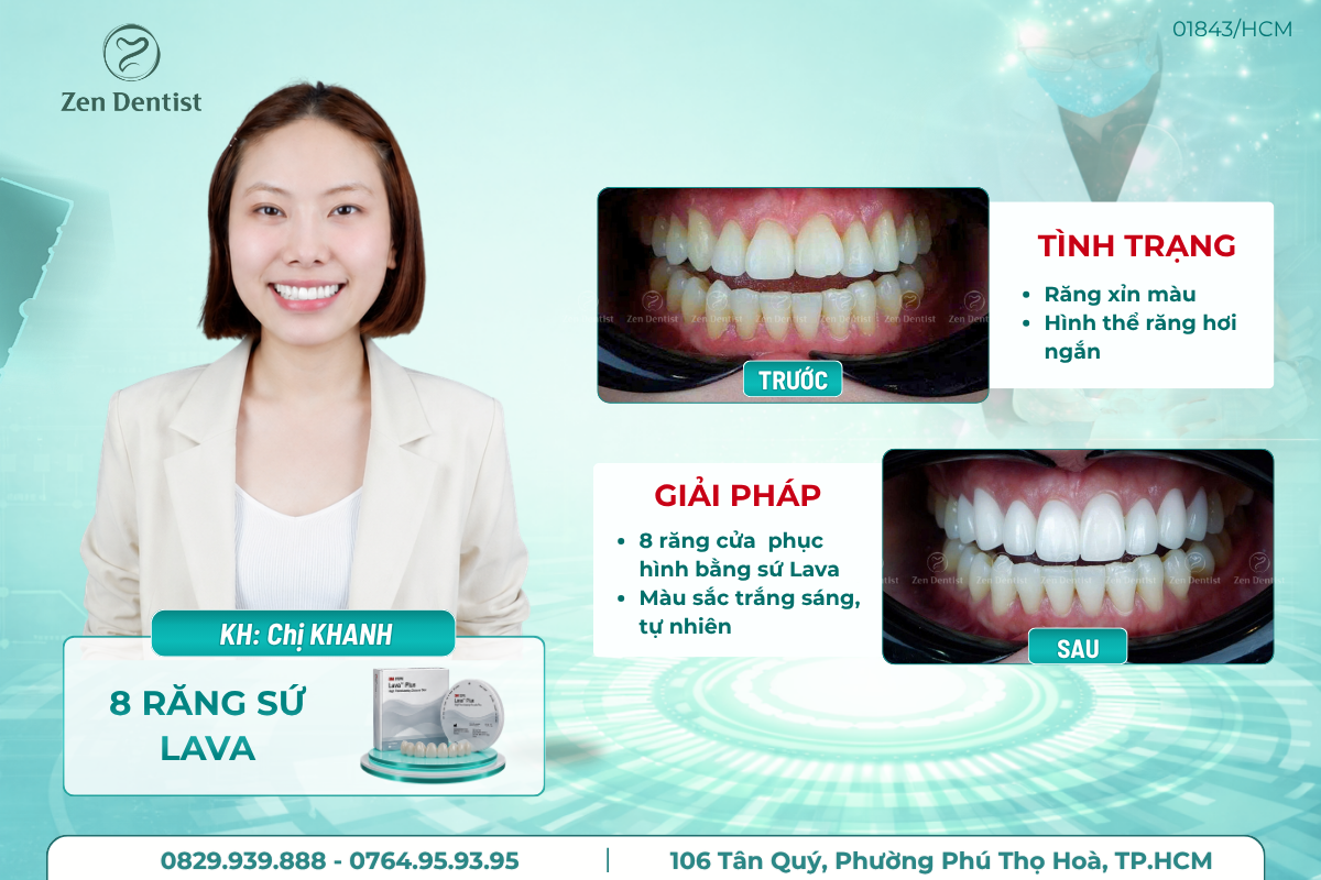 Làm răng sứ an toàn tại Zen Dentist