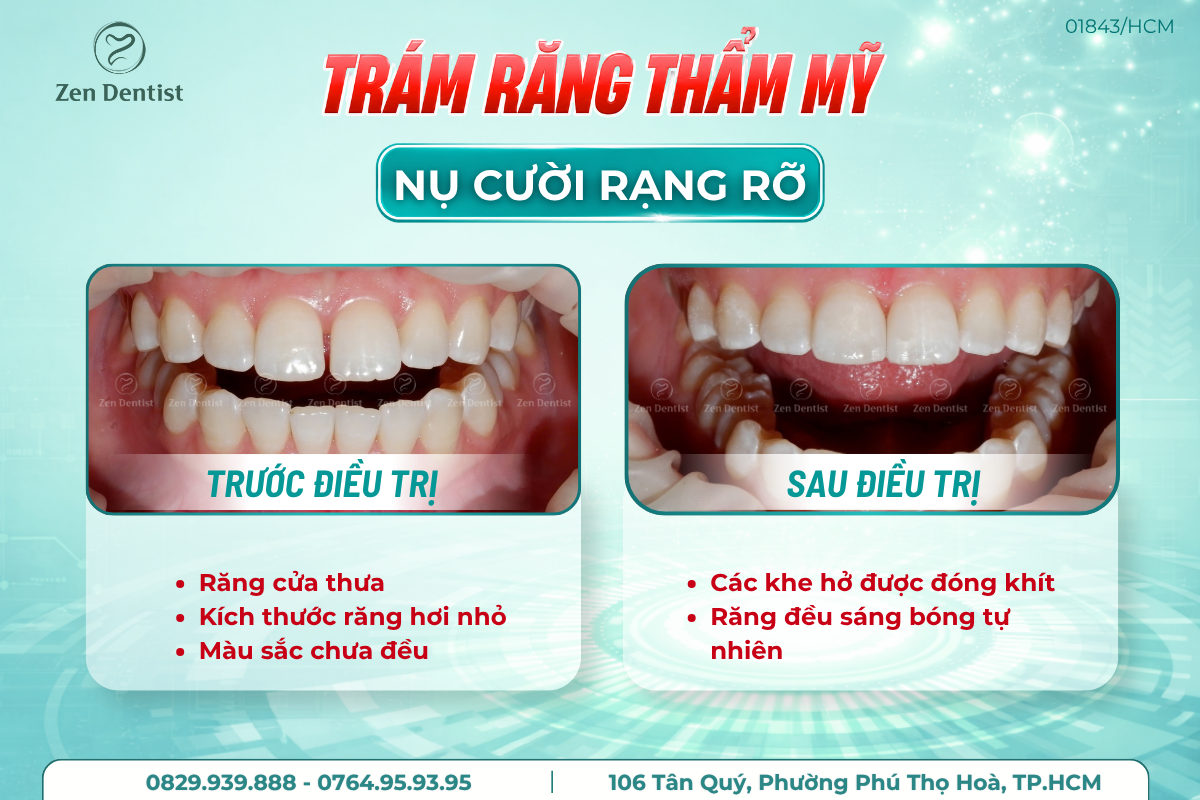 Trám răng thẩm mỹ cho răng thưa