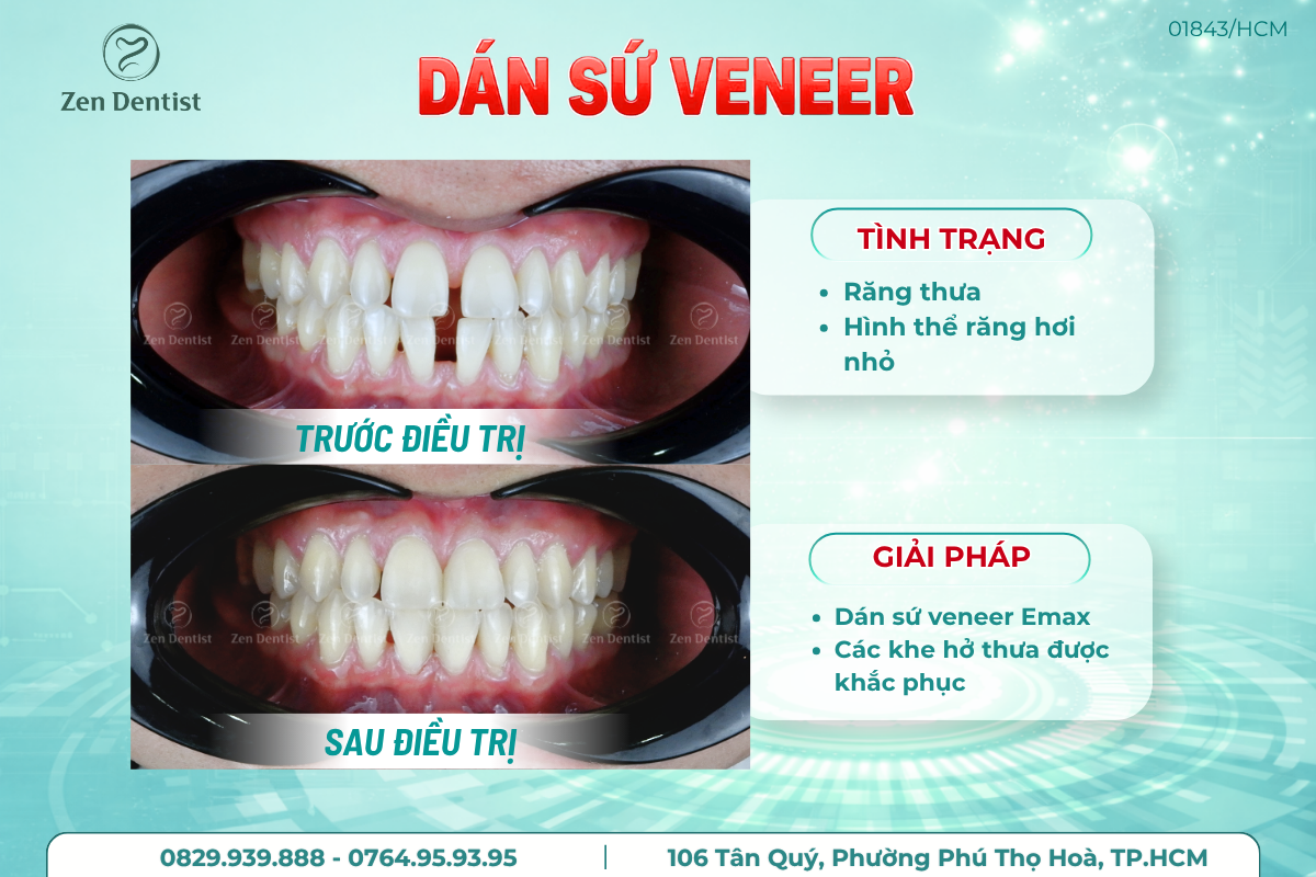 Dán sứ cho răng thưa