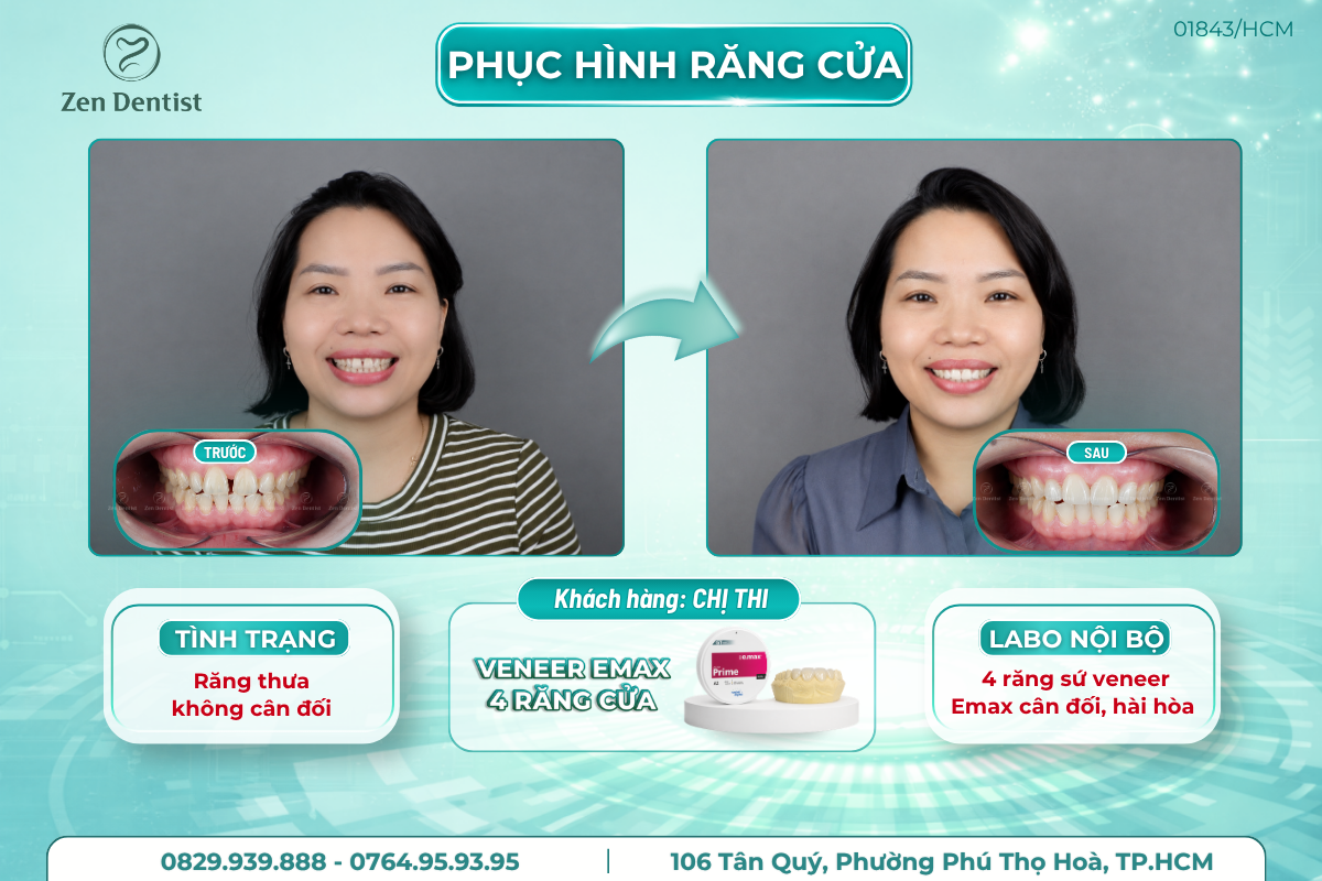 Phục hình răng cửa thưa bằng phương pháp dán sứ Veneer