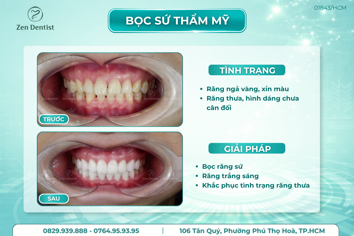 Bọc sứ thẩm mỹ cho răng thưa