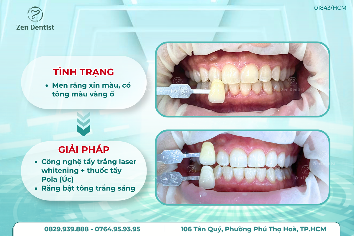 Tẩy trắng răng