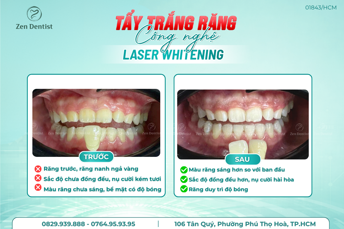 Tẩy trắng răng an toàn hiệu quả tại Zen Dentist